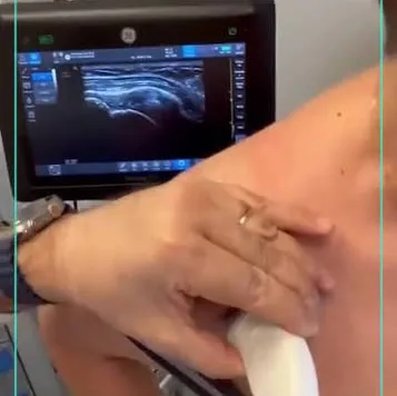 Ecografia della spalla con immagine del tendine sovraspinato a monitor